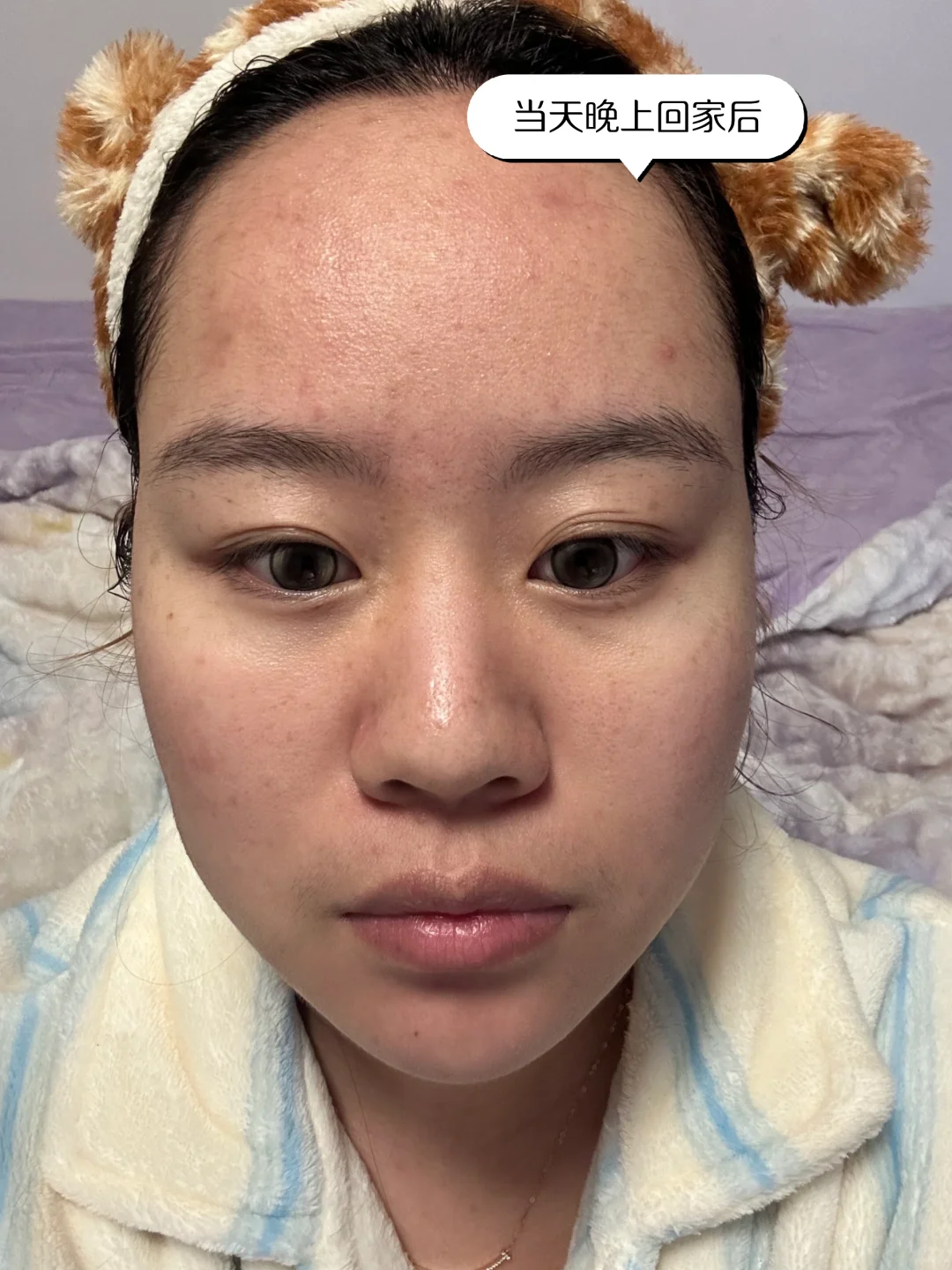 医美小白第一次光子嫩肤DAY5！