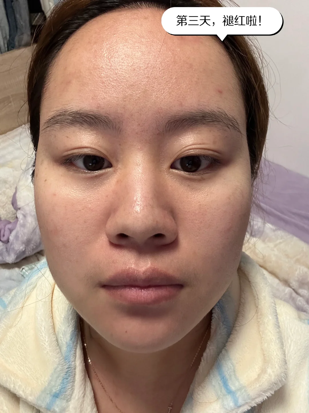 医美小白第一次光子嫩肤DAY5！