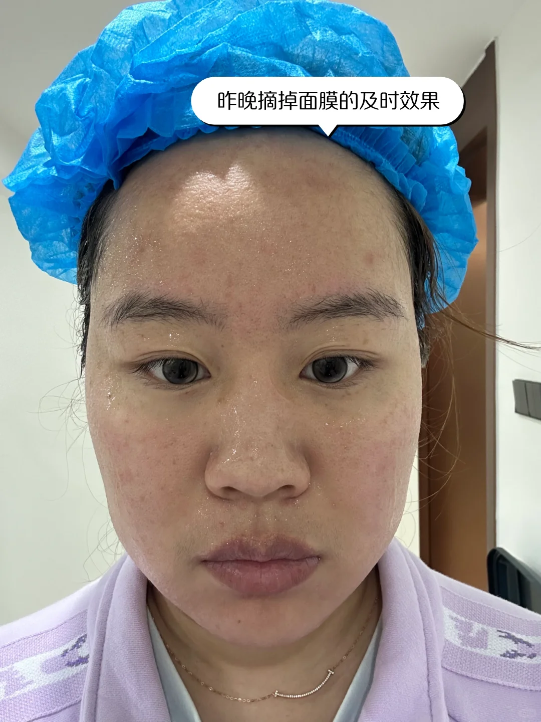 医美小白第一次光子嫩肤DAY5！