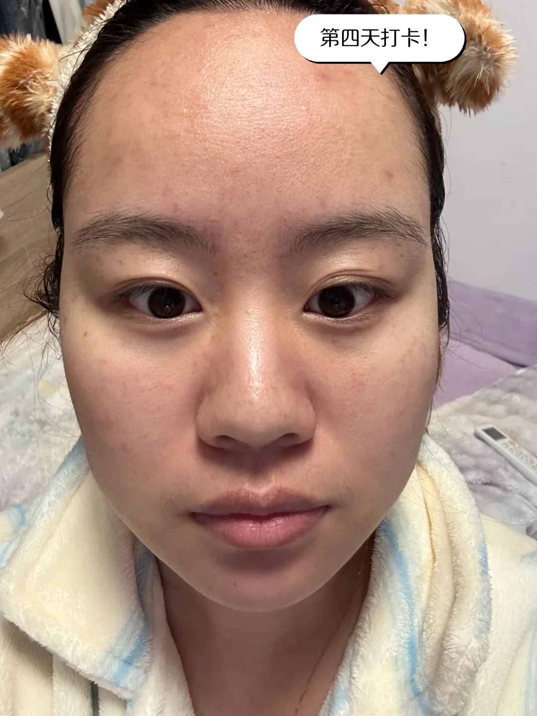 医美小白第一次光子嫩肤DAY5！