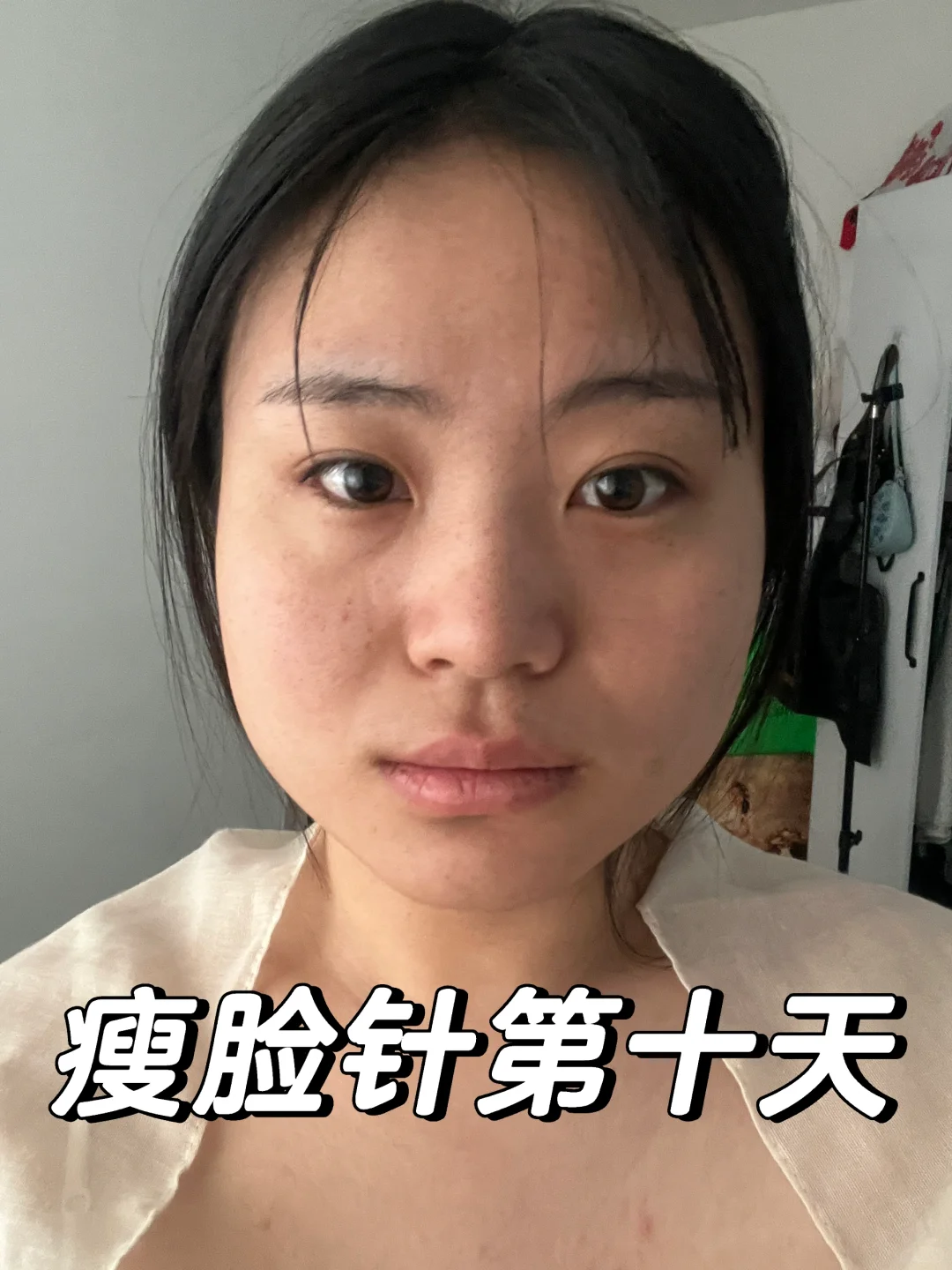 瘦脸针第10天📝