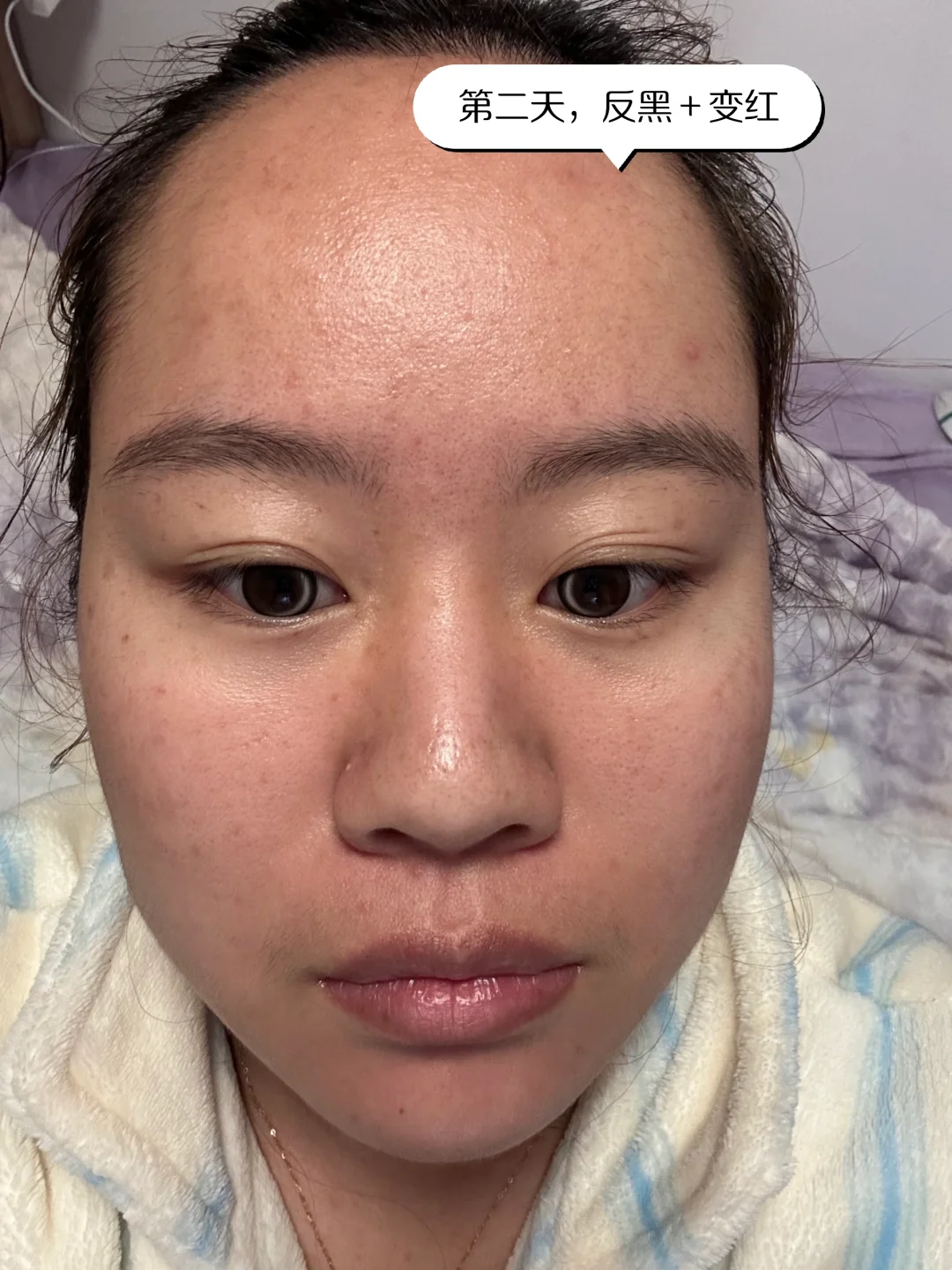 医美小白第一次光子嫩肤DAY5！