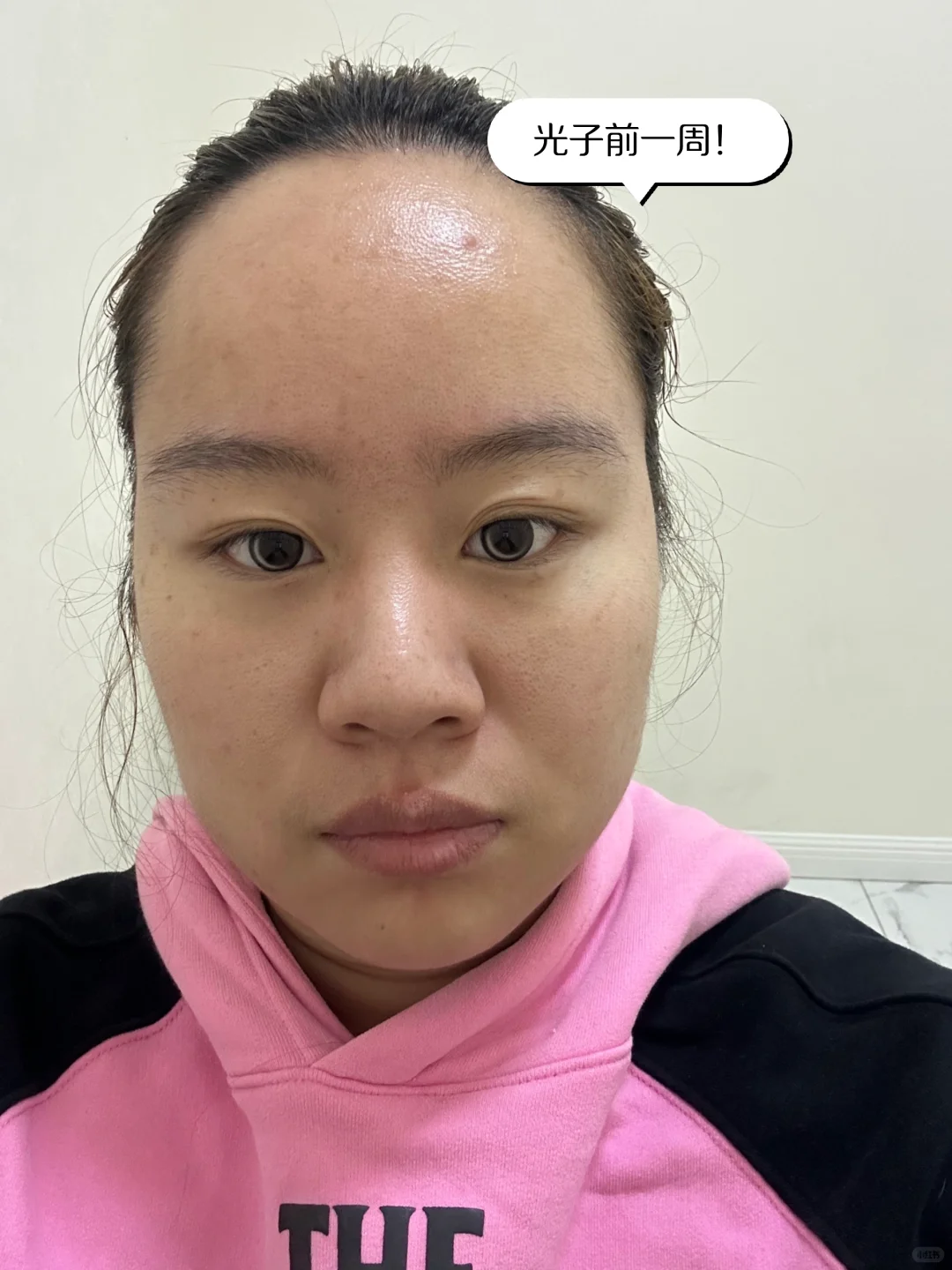 医美小白第一次光子嫩肤DAY5！
