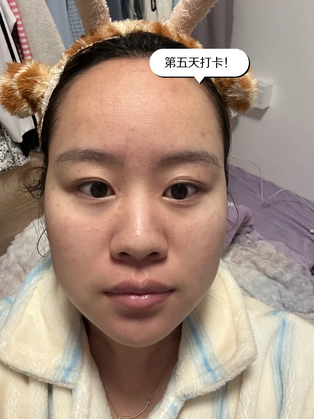 医美小白第一次光子嫩肤DAY5！