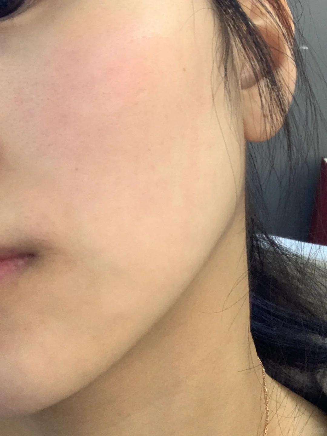玫瑰痤疮好皮打卡记录