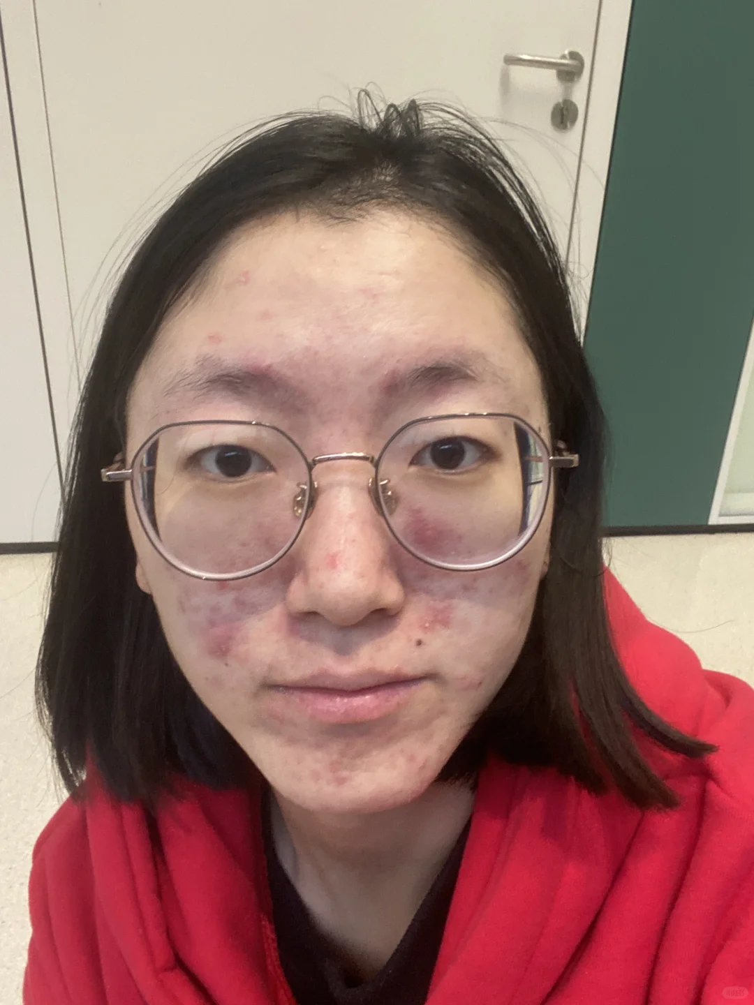 痘肌的痛我懂！左滑看我逆袭