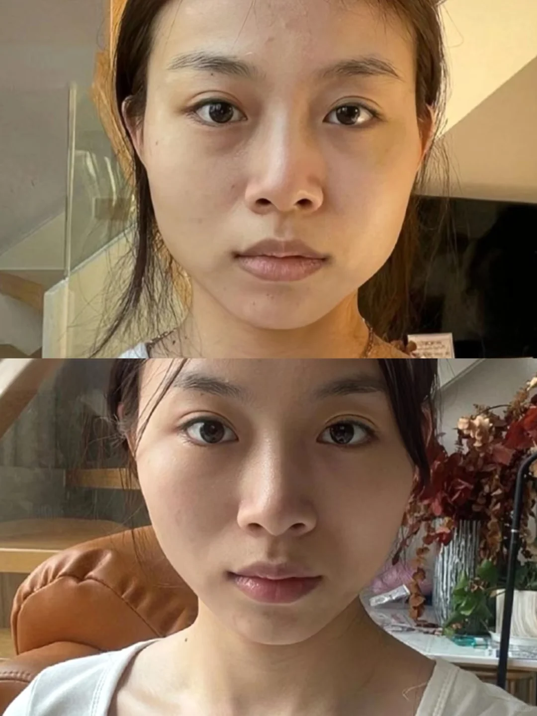 瘦脸针一个月了，对比看看