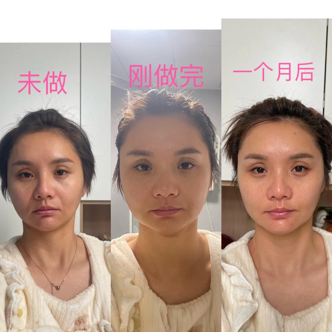 都说童颜💉后一月效果最佳