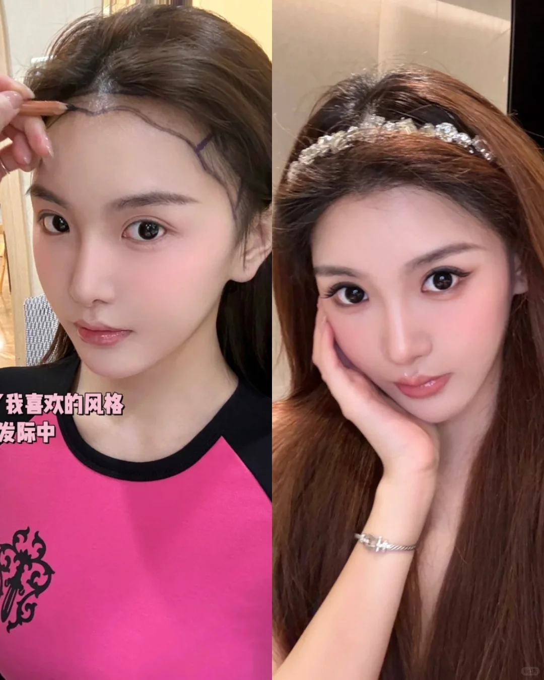 半年植发分享来了，头包脸太美了