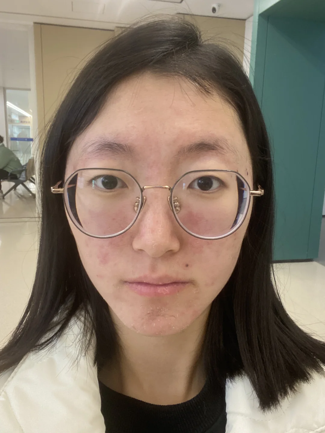 痘肌的痛我懂！左滑看我逆袭