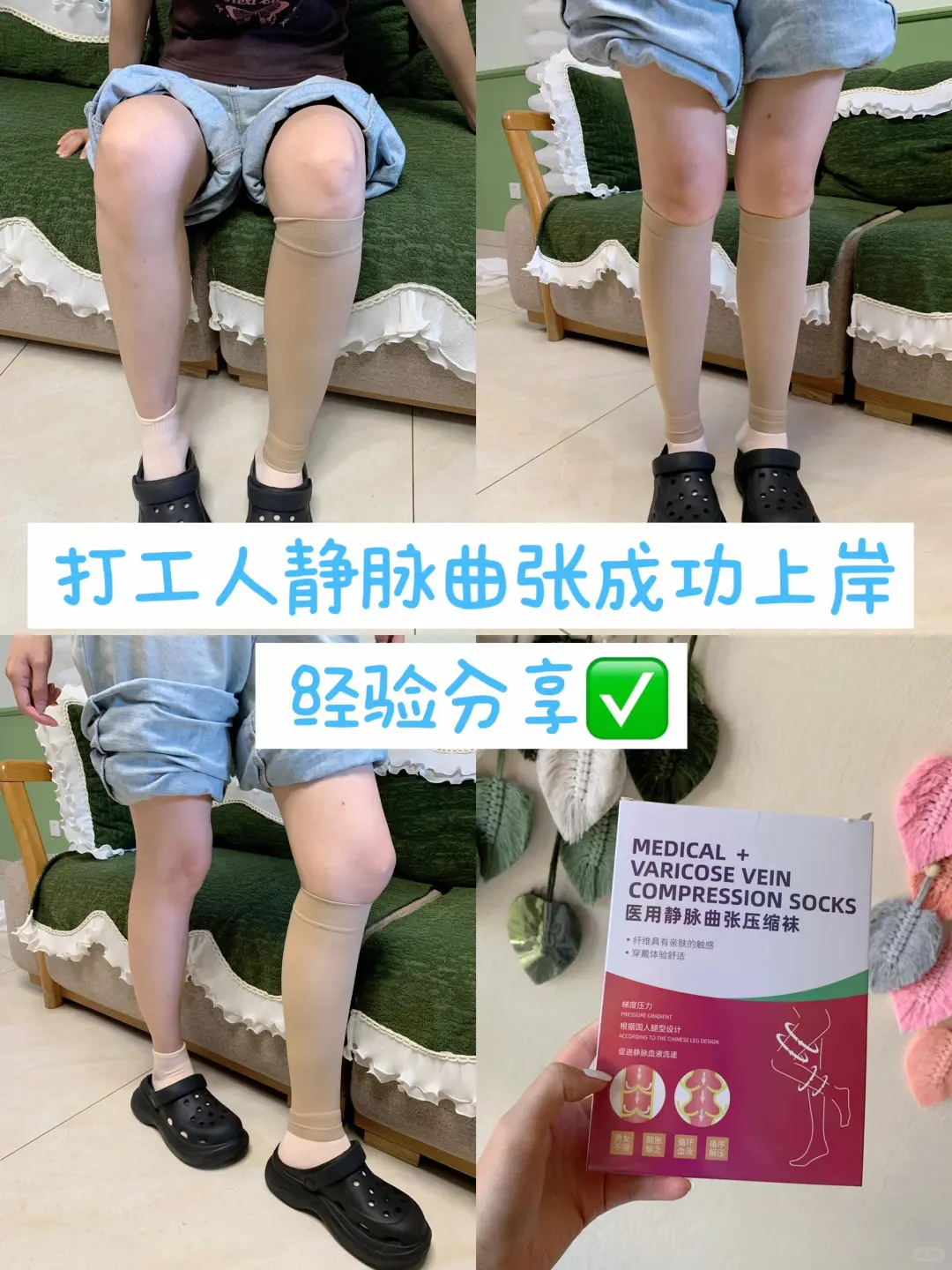 答应不删！腿上长静脉曲张的姐妹一定要注意