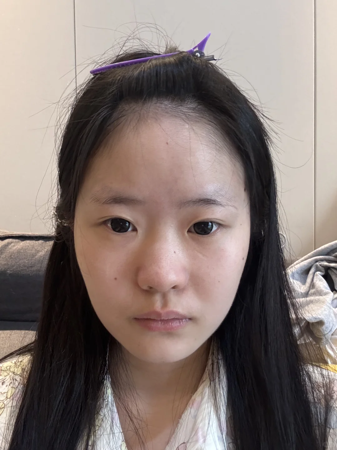 方圆脸瘦脸针效果