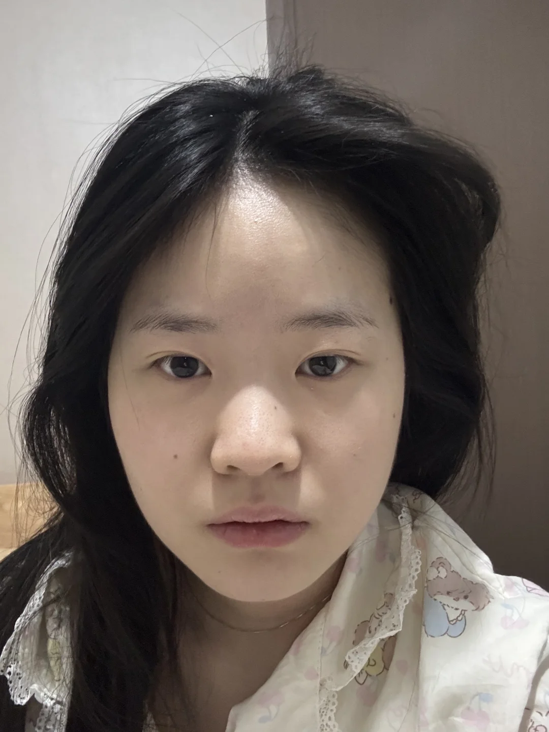 方圆脸瘦脸针效果