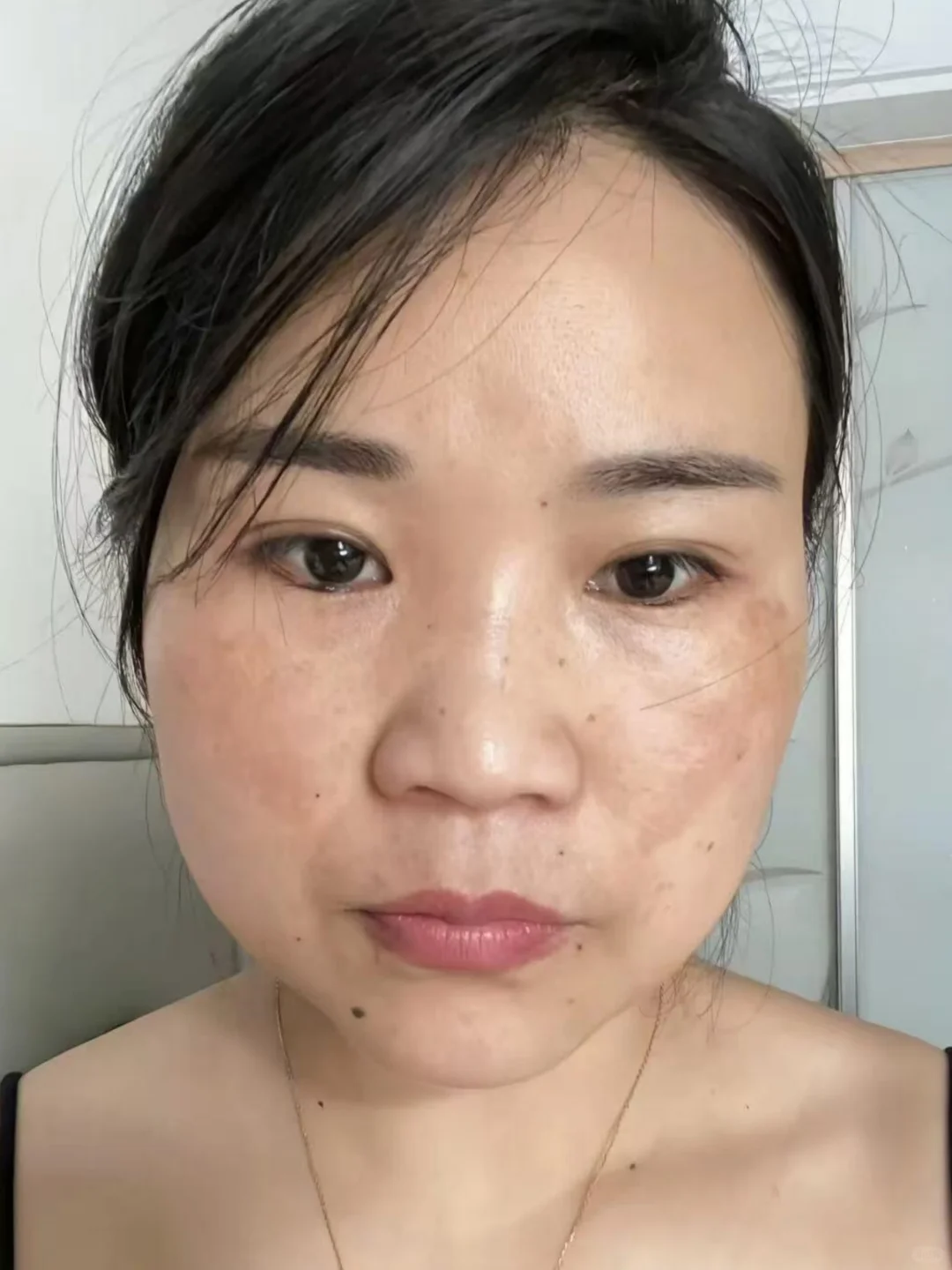 打卡三个月，倔强的黄褐斑不见了