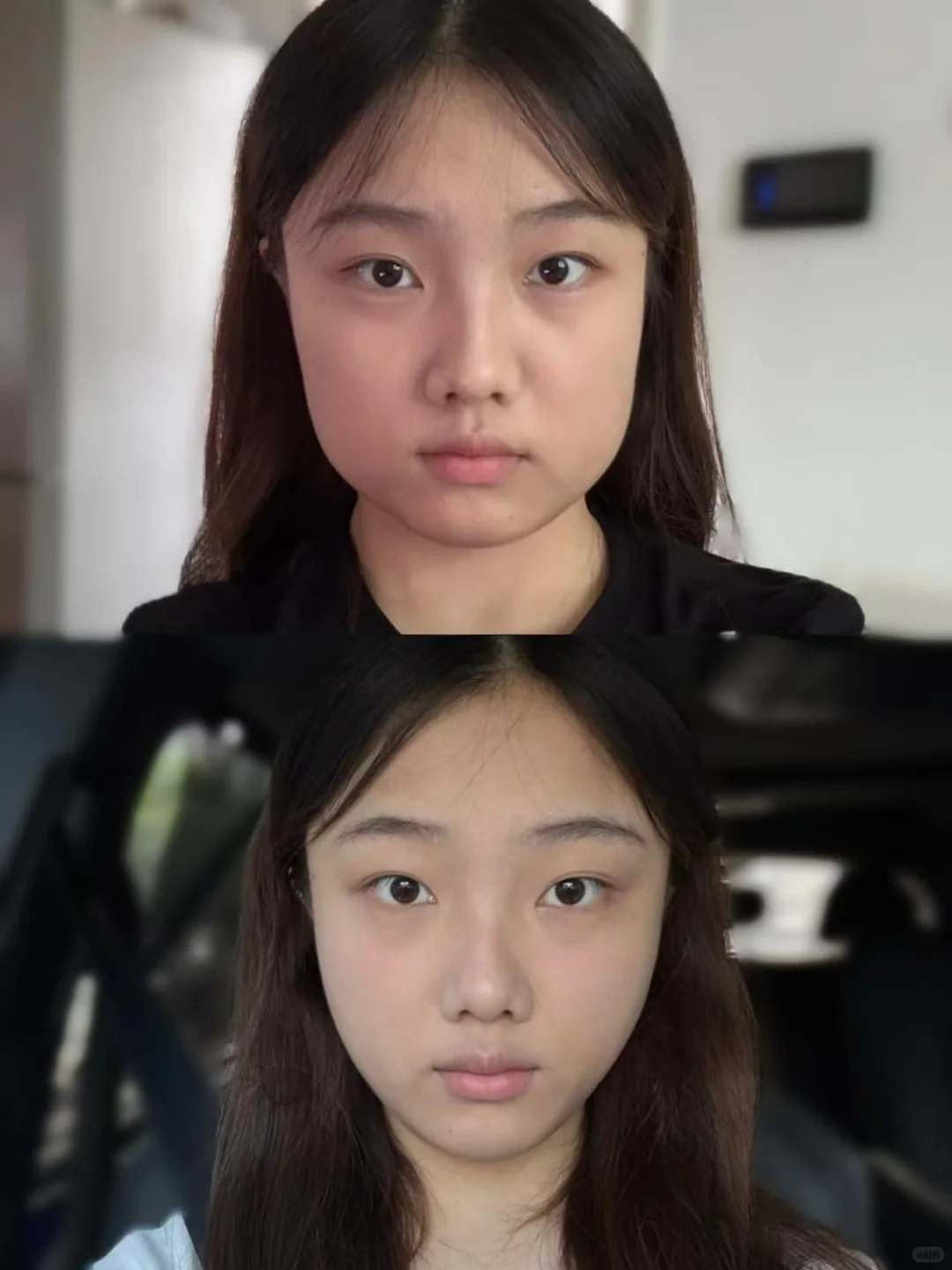 武汉3️⃣甲瘦脸1个月没凹来反馈了