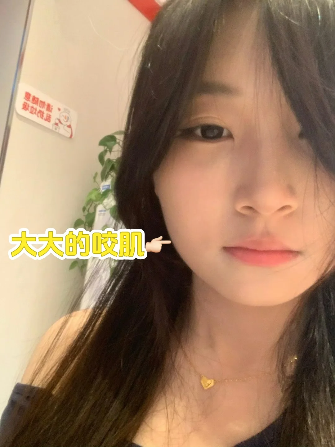 厦门瘦脸针一个月啦～每天都在偷乐😄