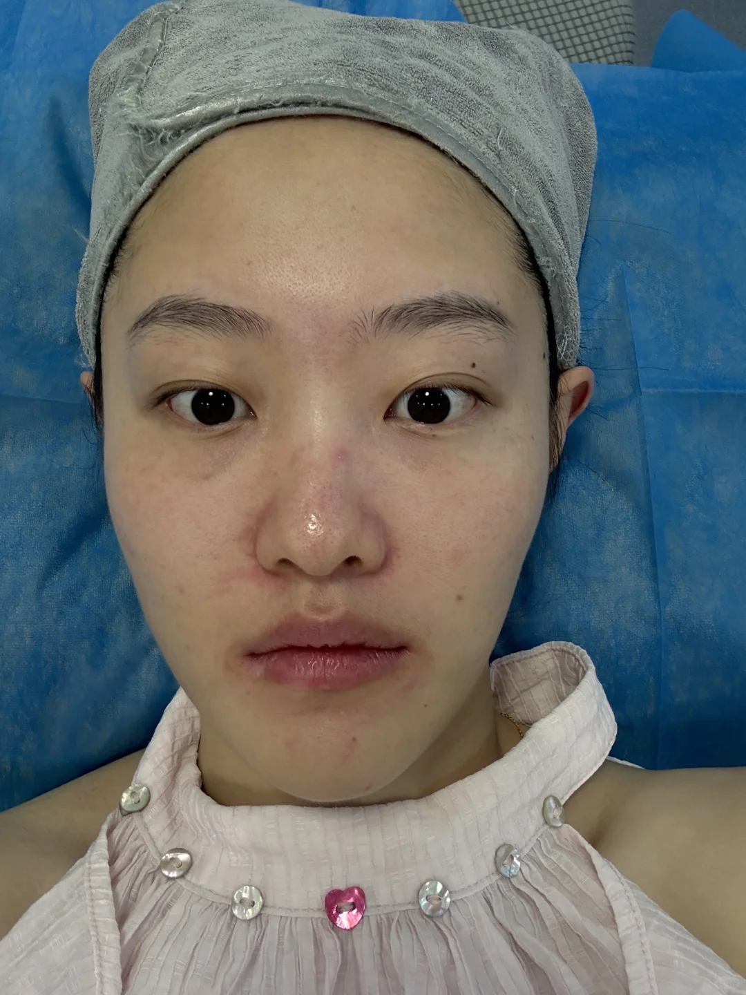 记录打完光子嫩肤的一段时间后