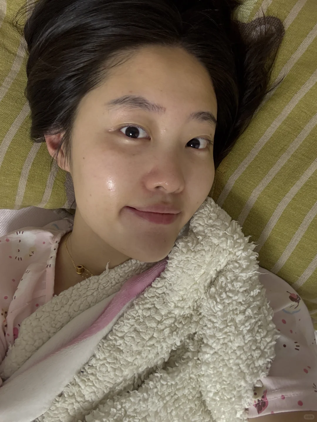 记录打完光子嫩肤的一段时间后