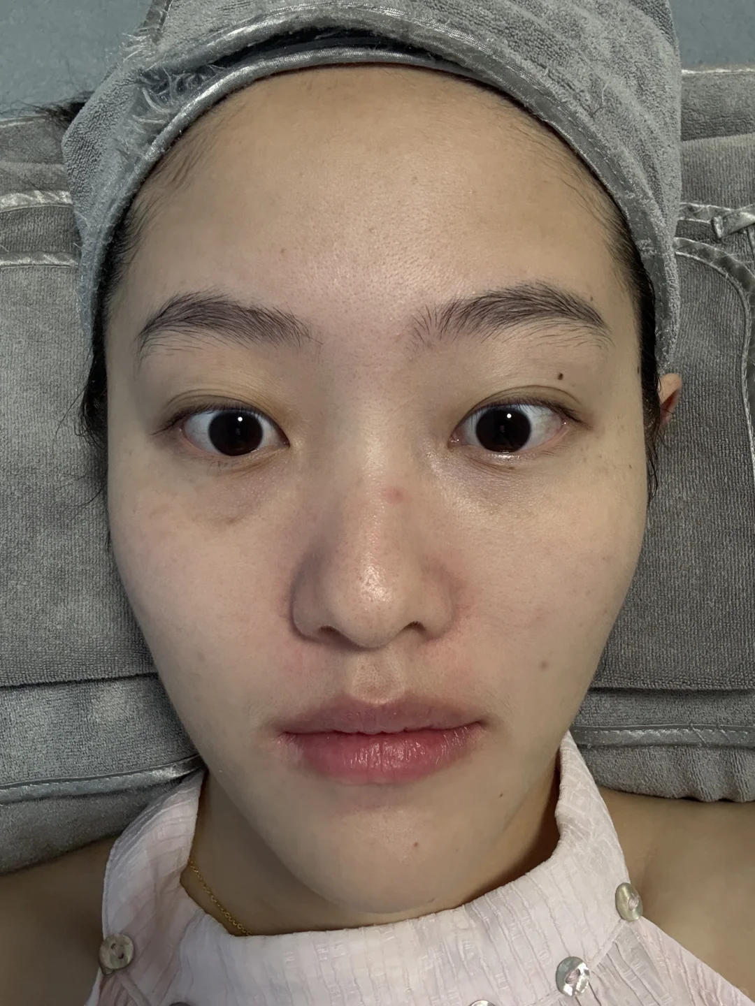 记录打完光子嫩肤的一段时间后