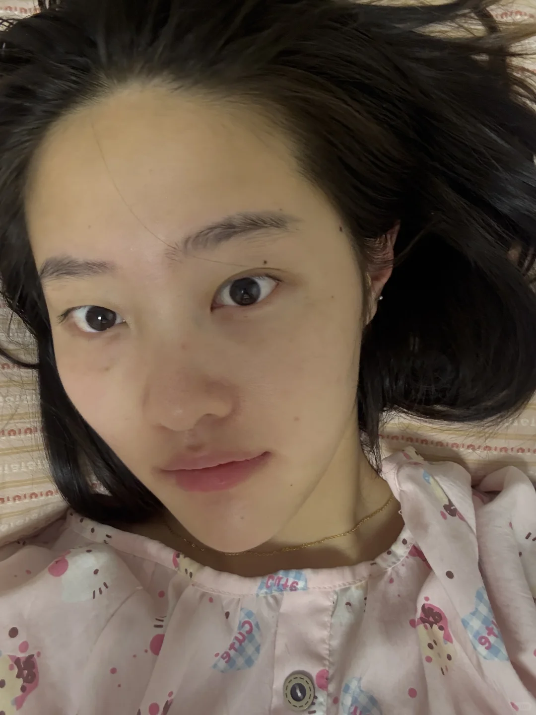 记录打完光子嫩肤的一段时间后