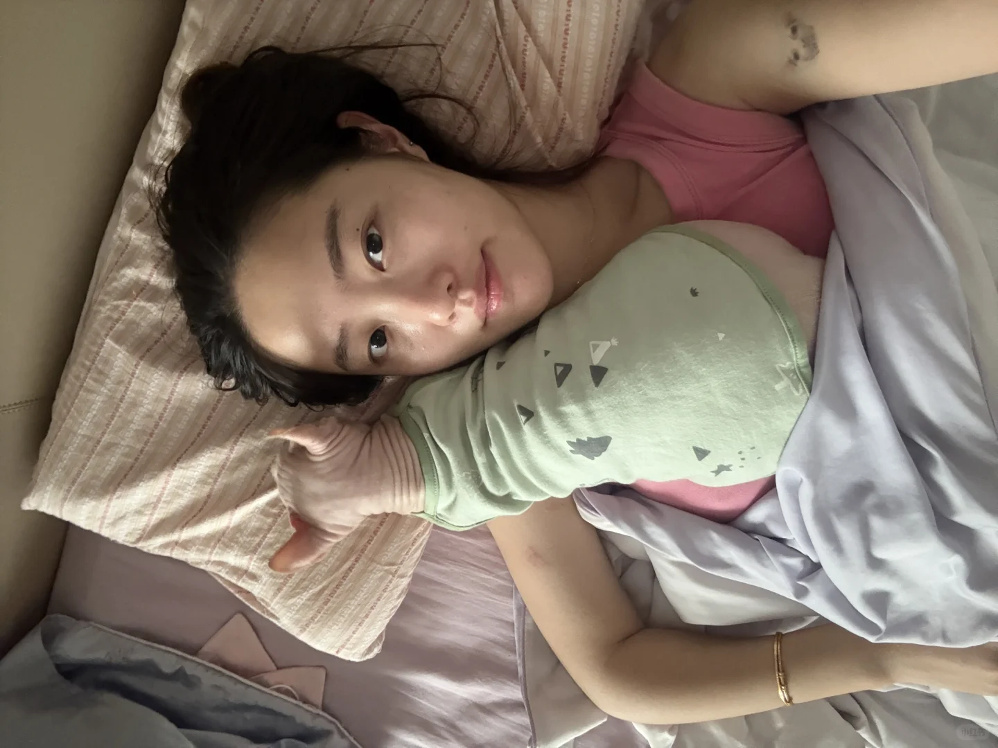 记录打完光子嫩肤的一段时间后
