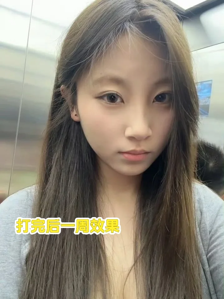 厦门瘦脸针一个月啦～每天都在偷乐😄