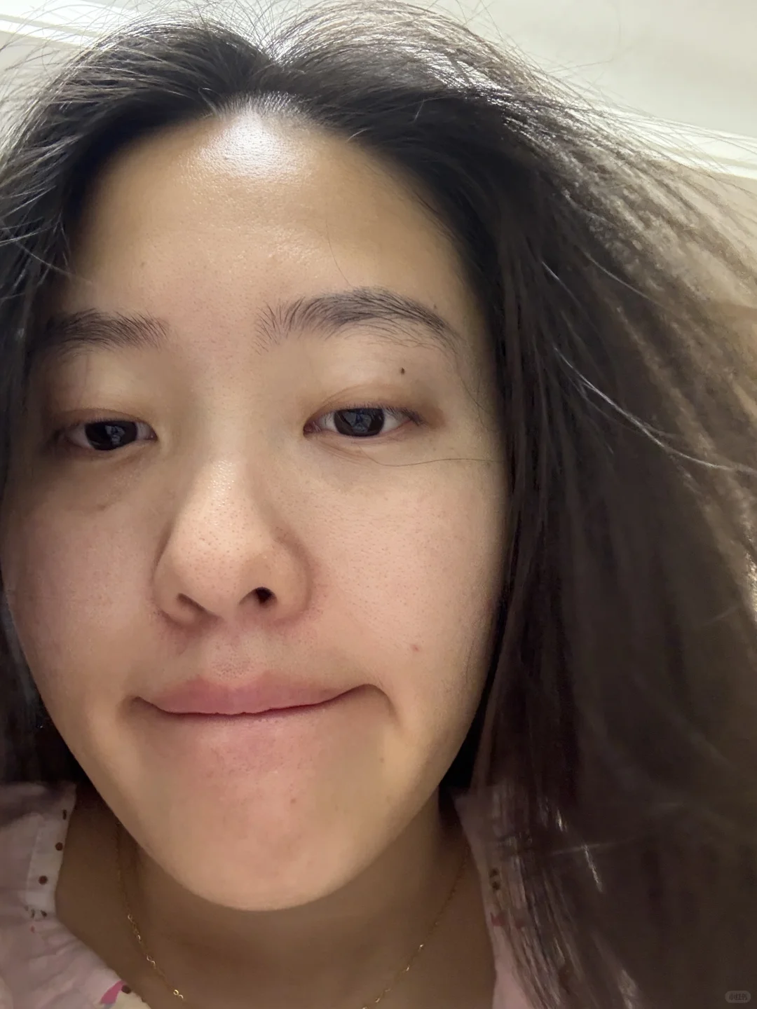 记录打完光子嫩肤的一段时间后