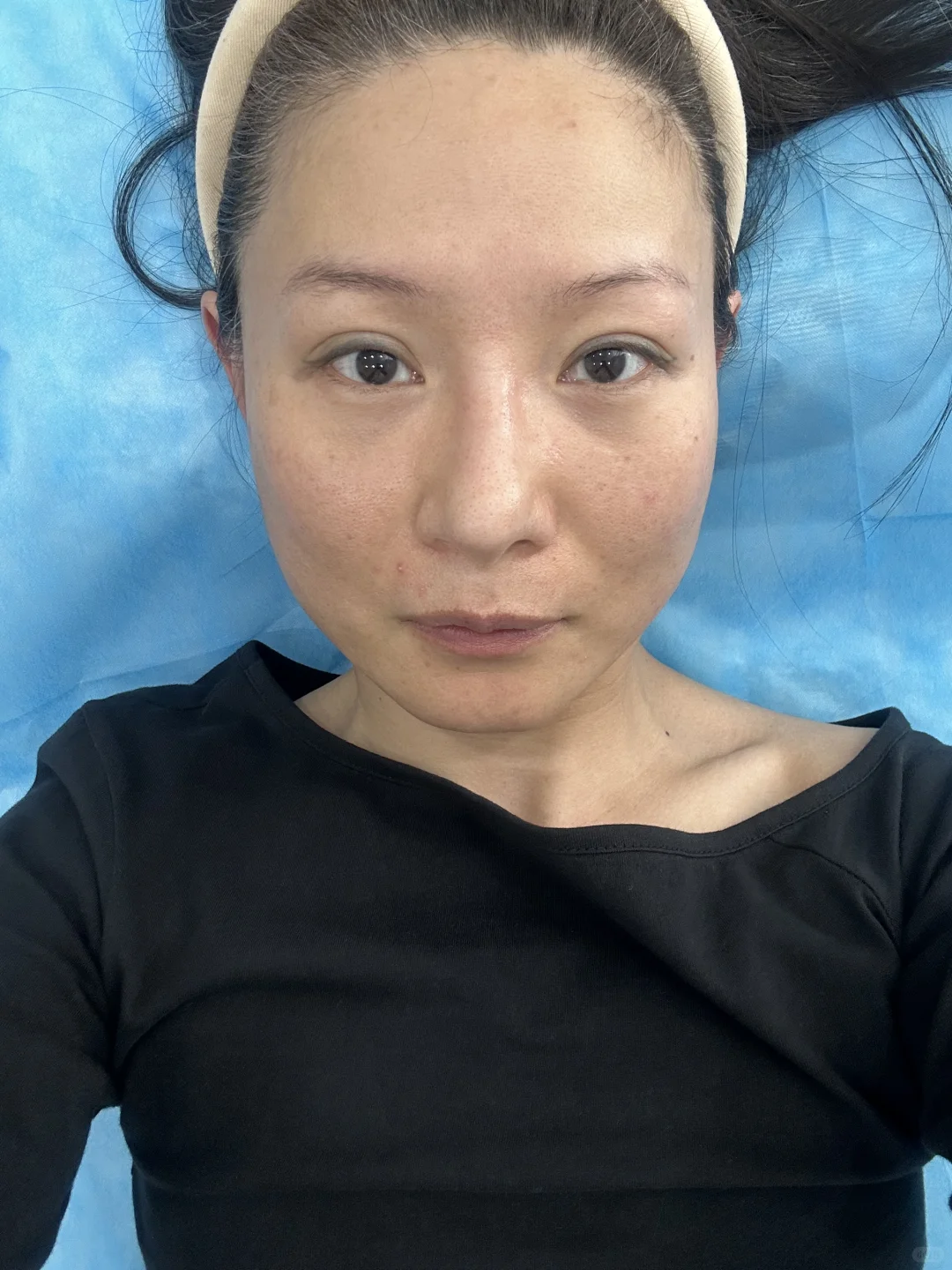 40+第一次打肉毒