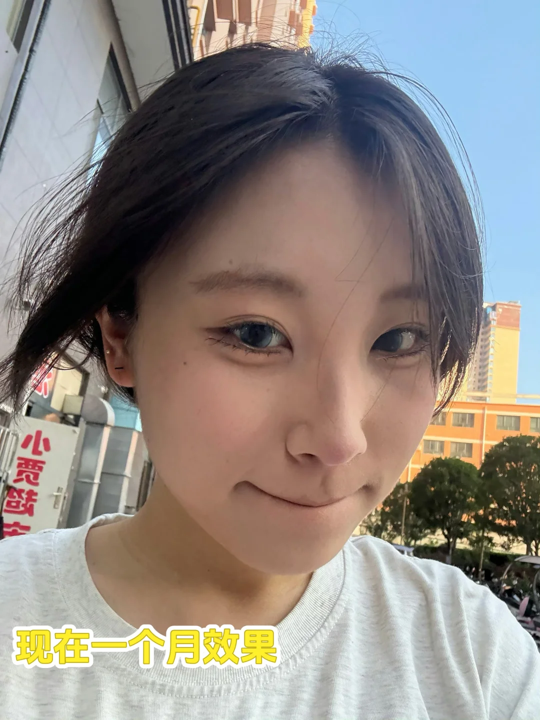 厦门瘦脸针一个月啦～每天都在偷乐😄