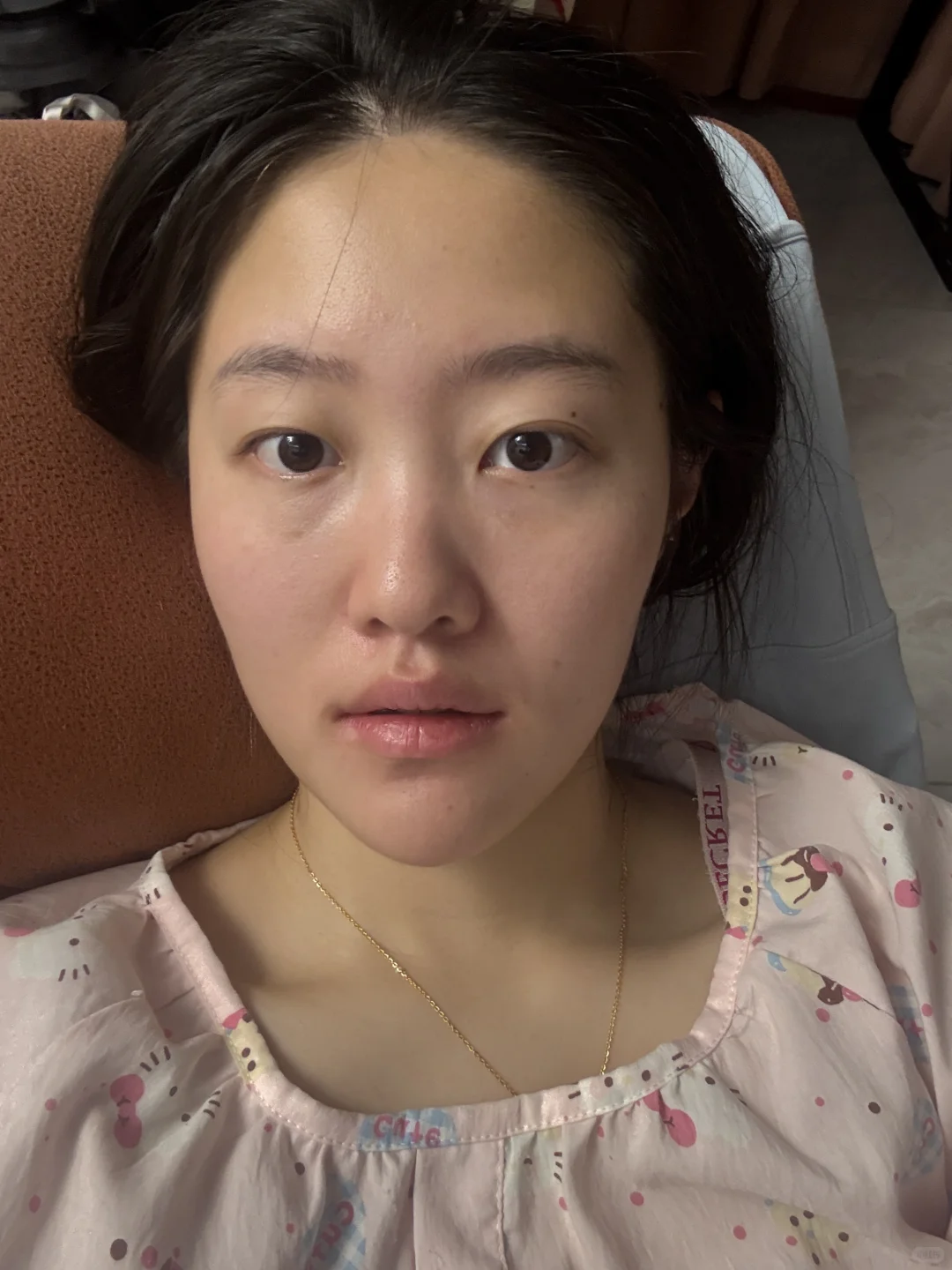 记录打完光子嫩肤的一段时间后