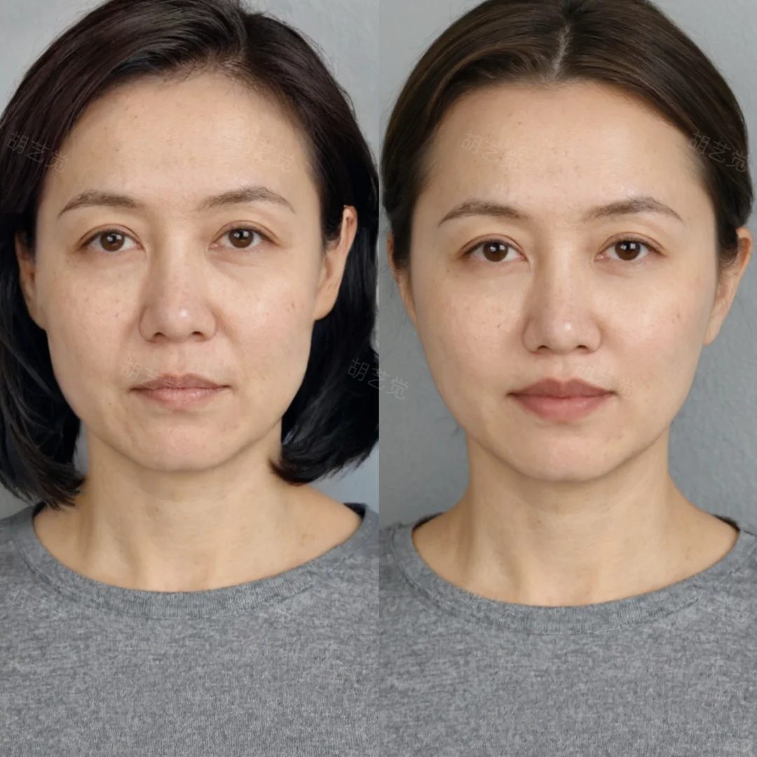 40+抗衰 告别面部‘松垮垂’，自然年轻态～