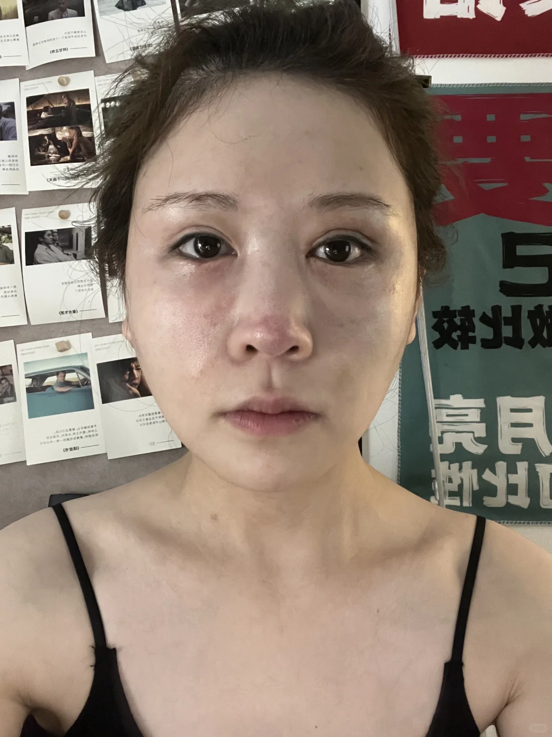 面颊凹了别焦虑！脂肪三天填回来