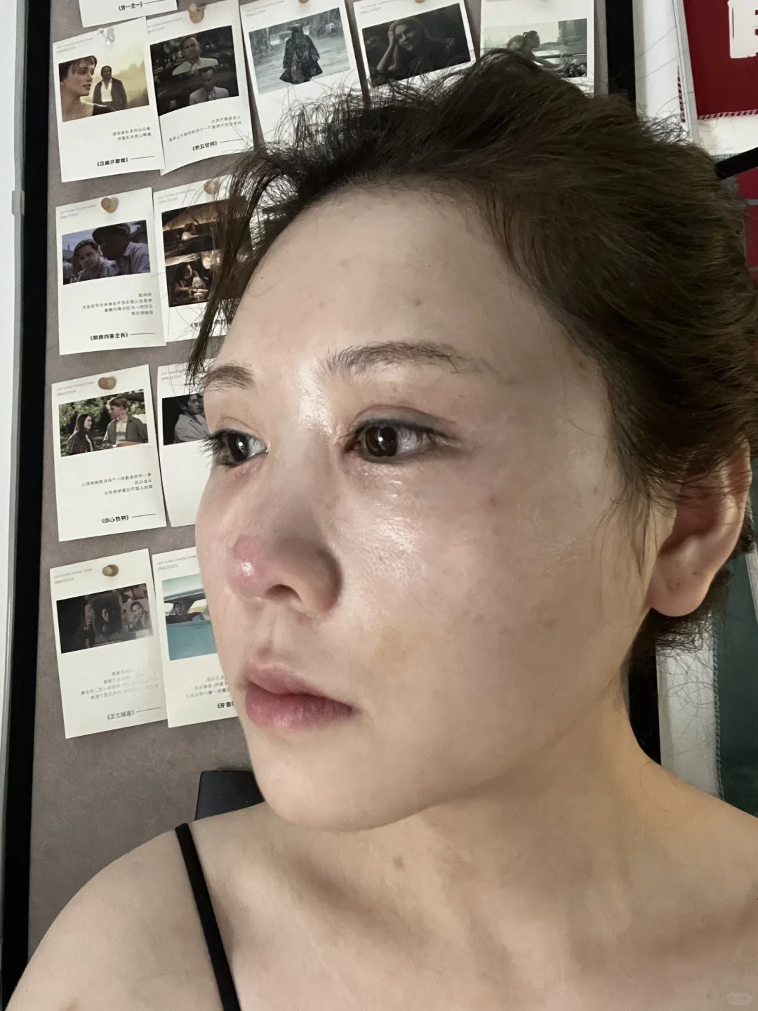 面颊凹了别焦虑！脂肪三天填回来