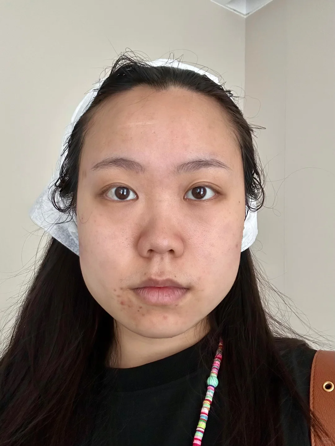 左滑看肉毒一个月
