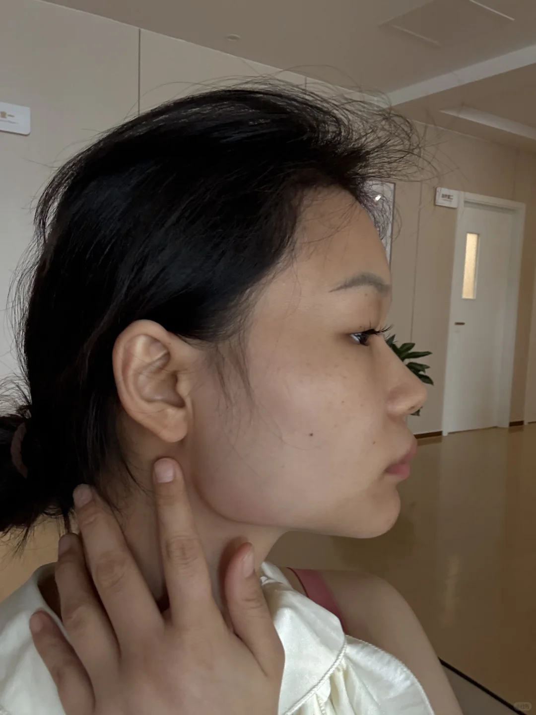 瘦脸 肉毒素