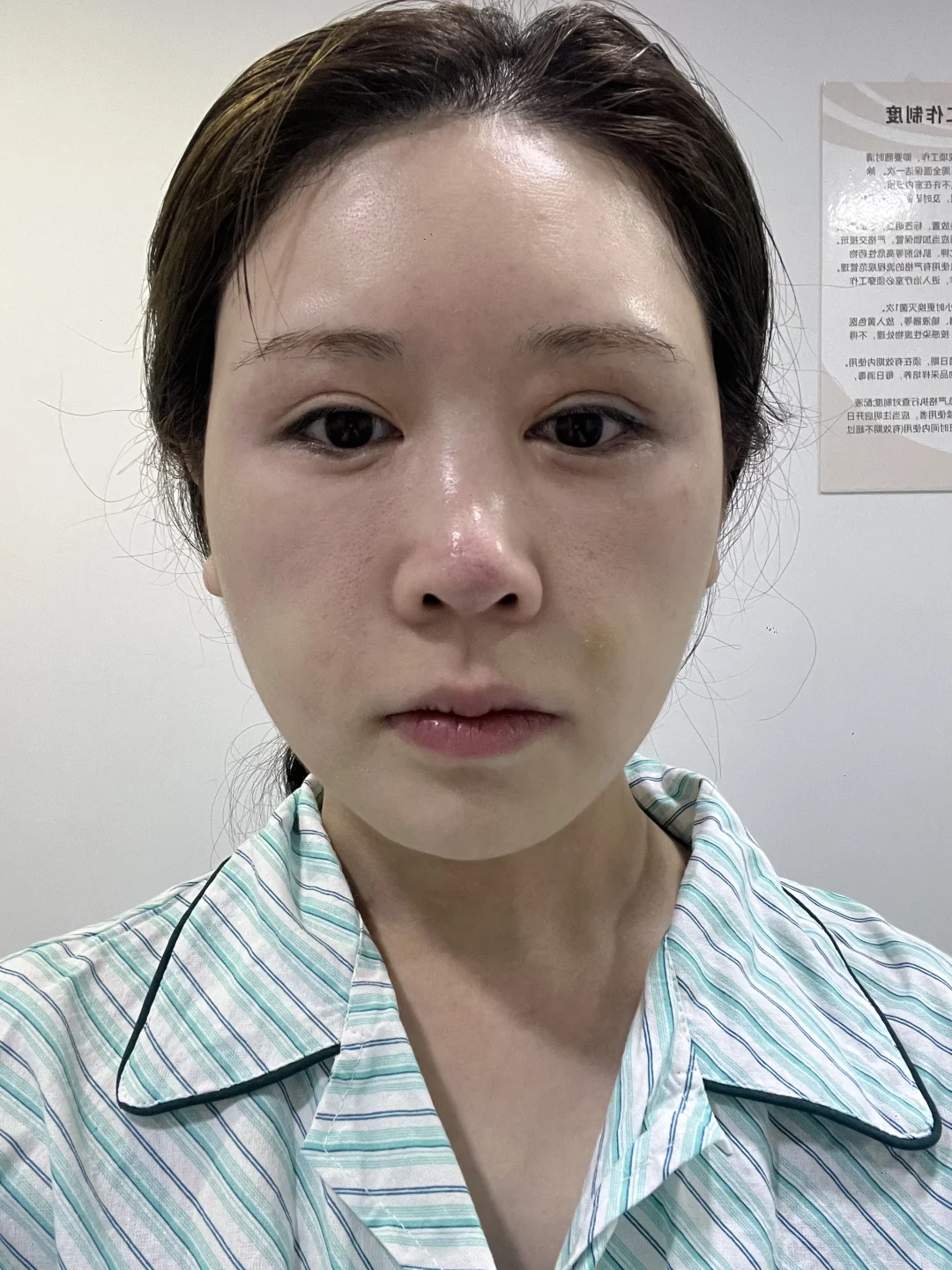 面颊凹了别焦虑！脂肪三天填回来