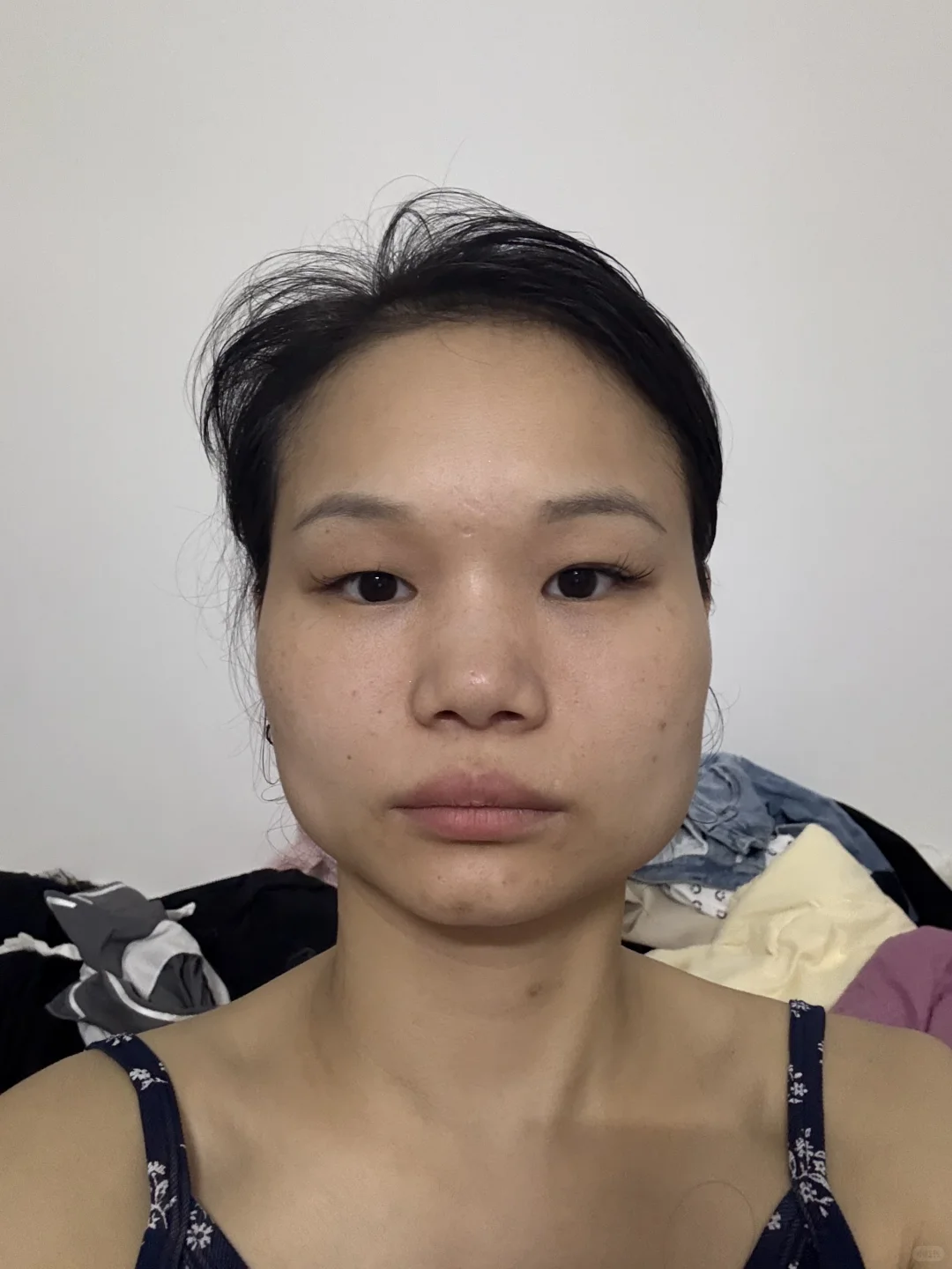 瘦脸 肉毒素