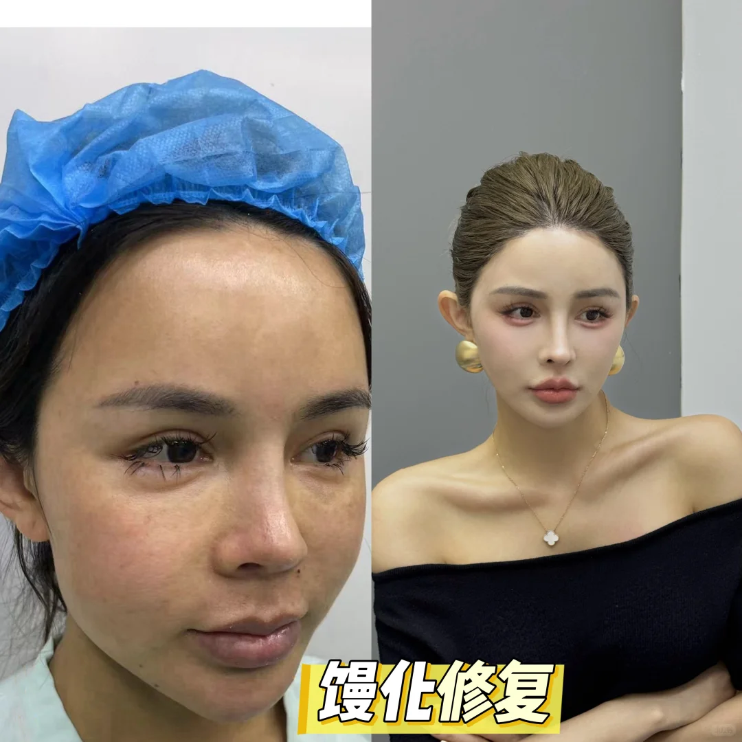 谁懂啊医美漫画脸修复打板招募，效果绝绝 子