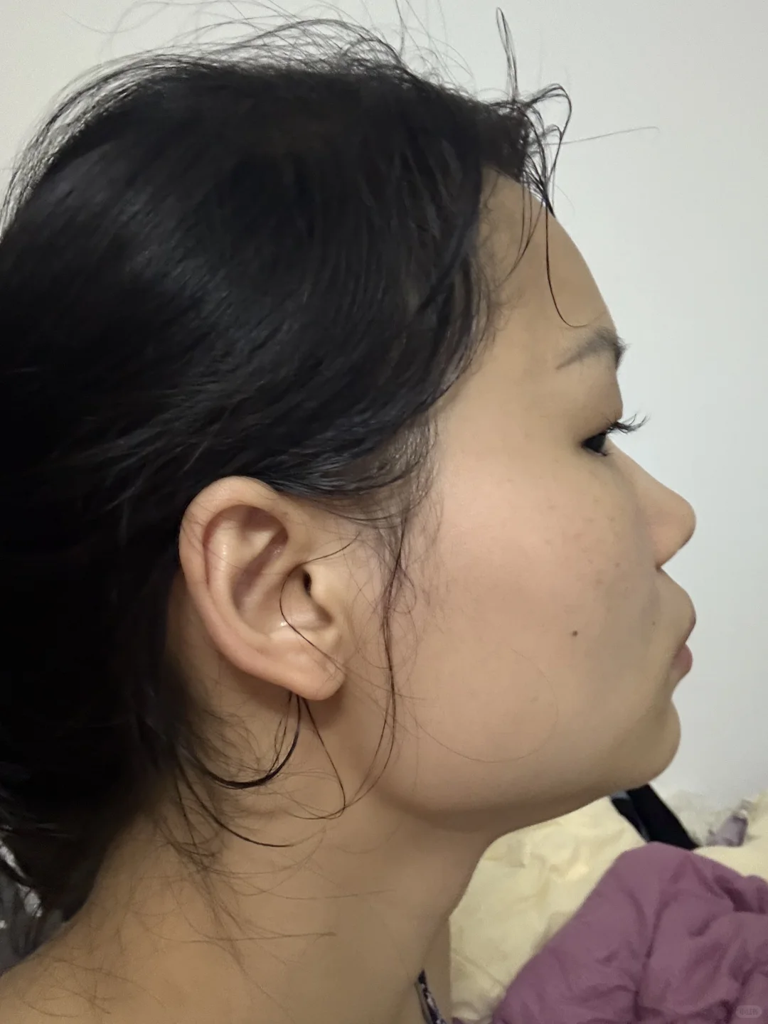 瘦脸 肉毒素