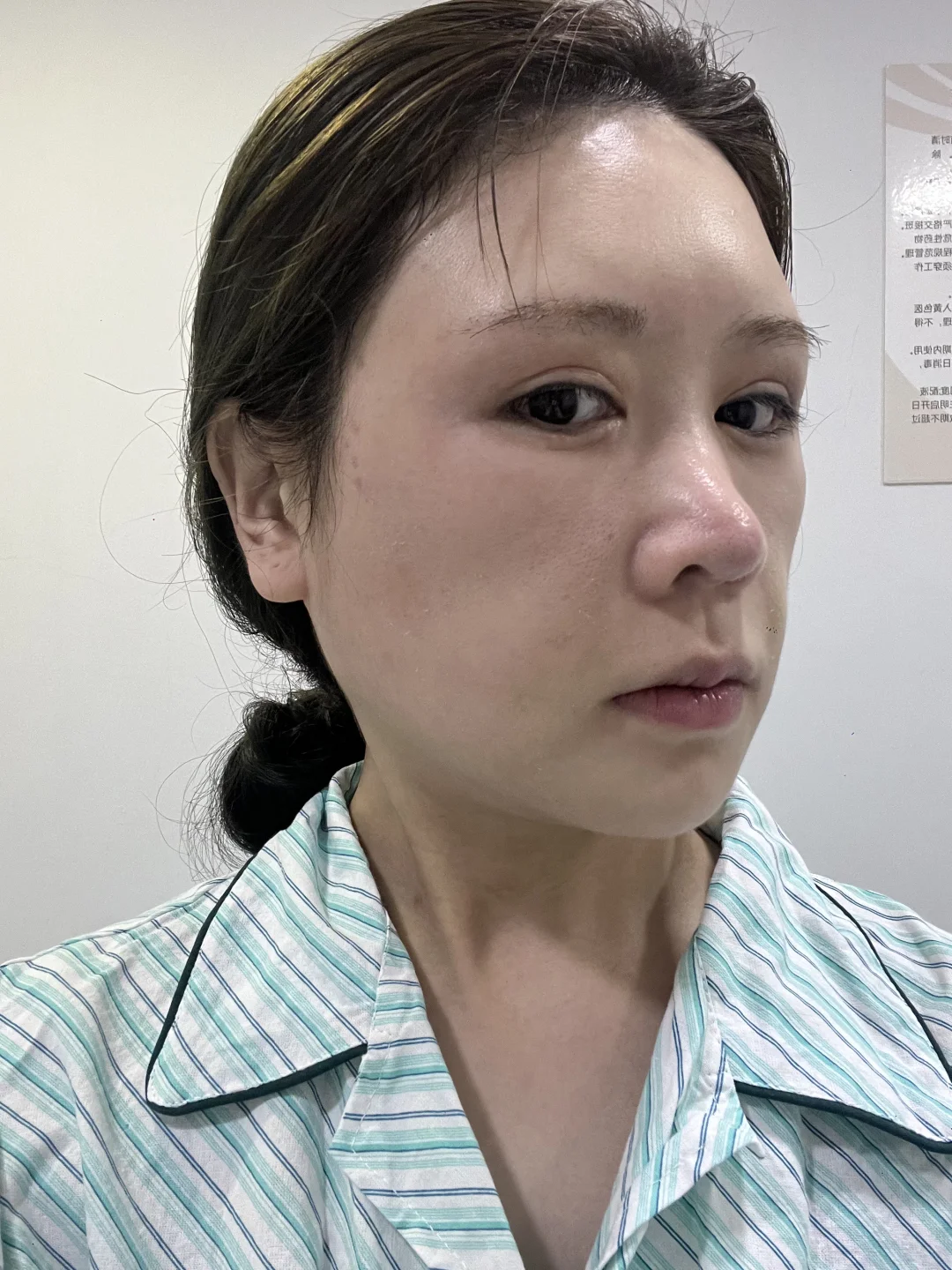 面颊凹了别焦虑！脂肪三天填回来