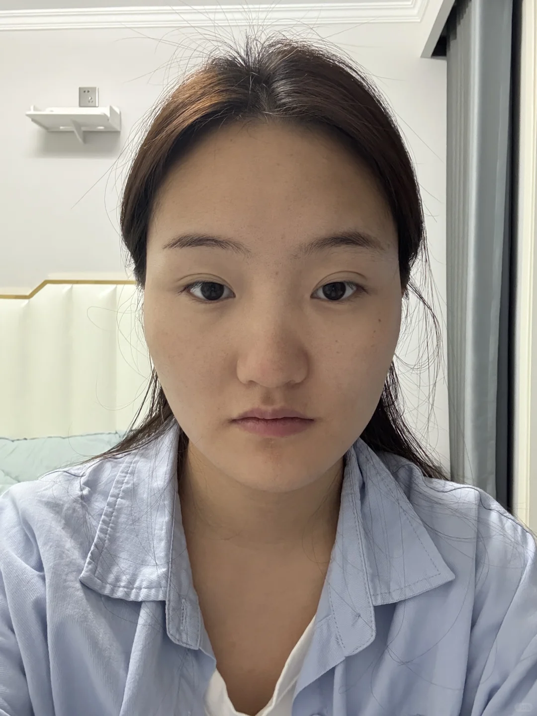 面部凹陷