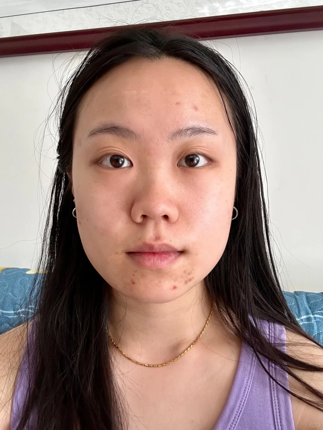 左滑看肉毒一个月