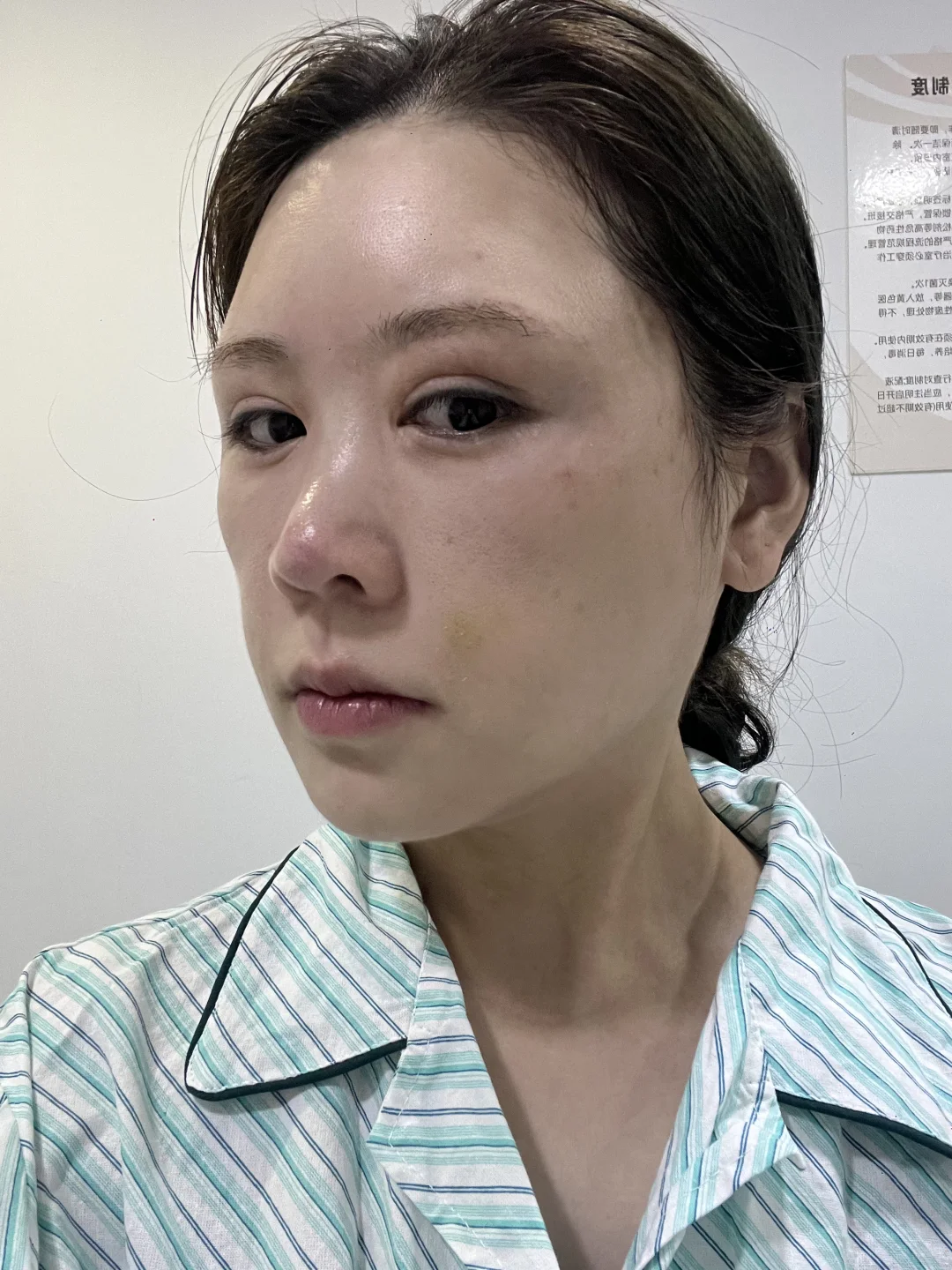 面颊凹了别焦虑！脂肪三天填回来