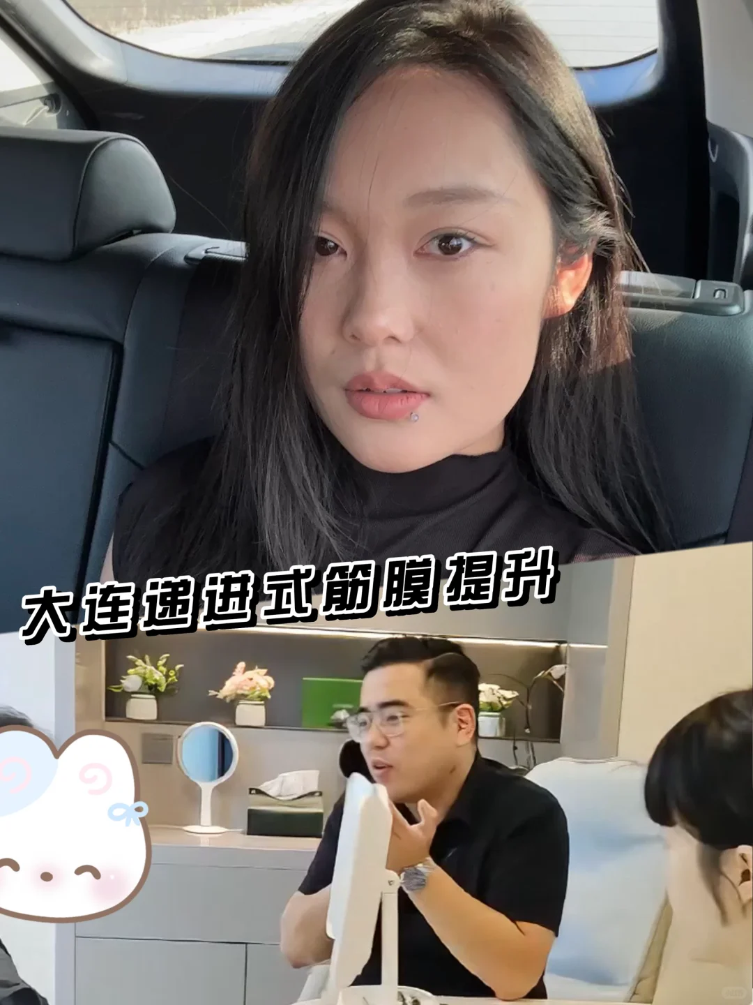 在大连do了筋膜提升