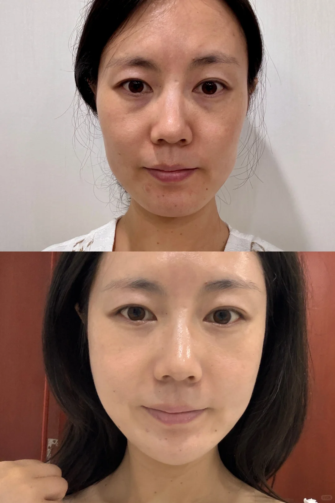 北京30+脸垮 太阳穴凹 用童颜一个月了咋样