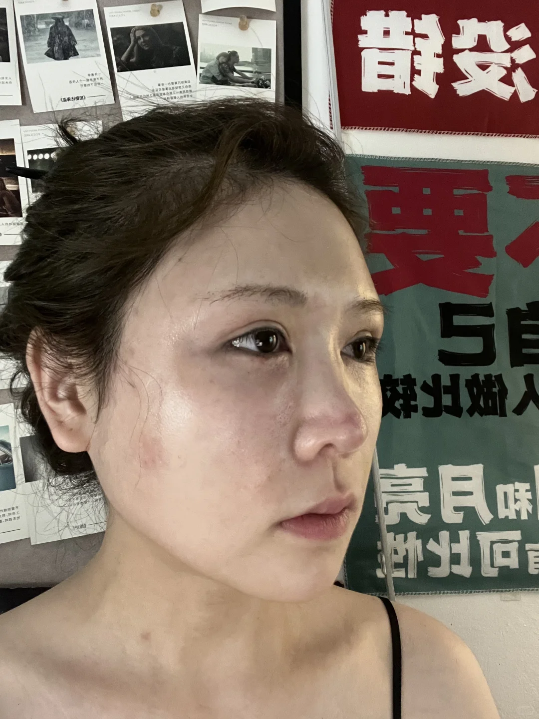 面颊凹了别焦虑！脂肪三天填回来