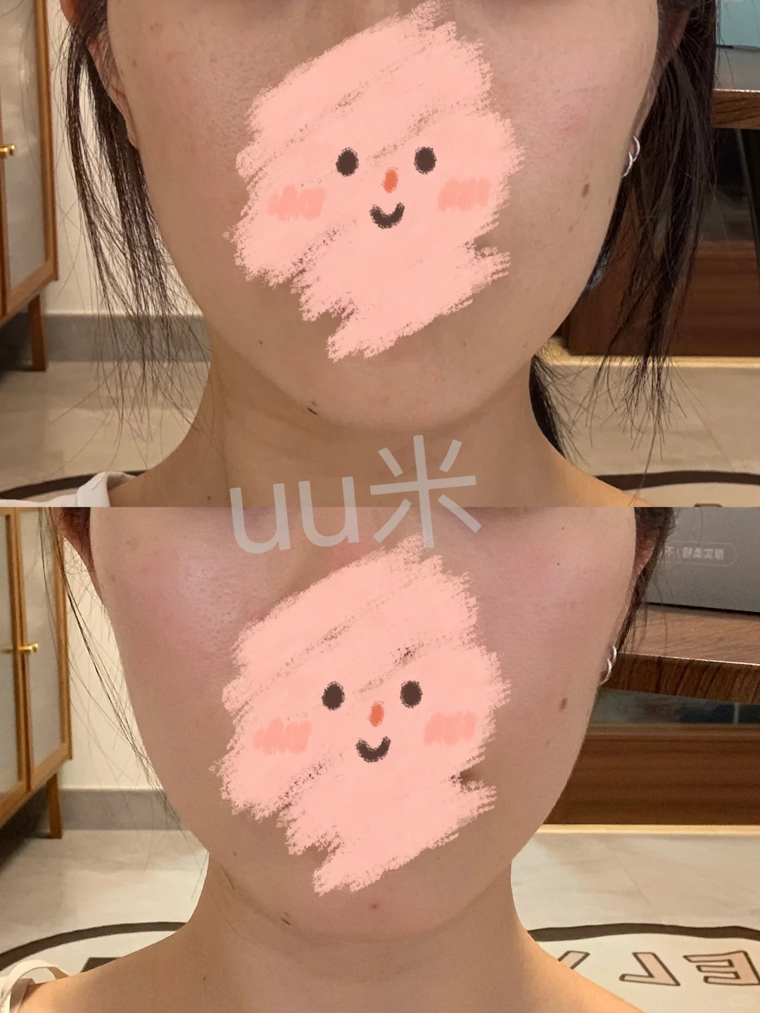 关于打下颌缘提升及咬肌的小小后续
