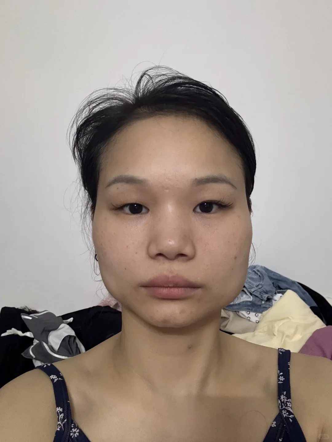 瘦脸 肉毒素