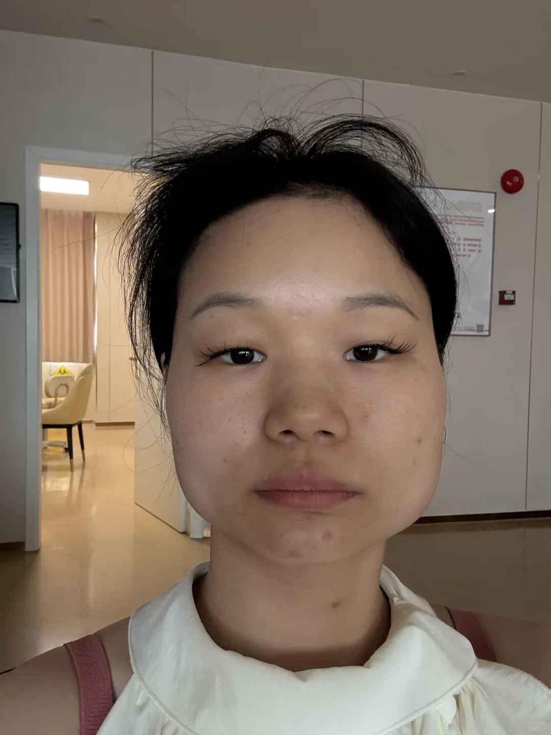 瘦脸 肉毒素