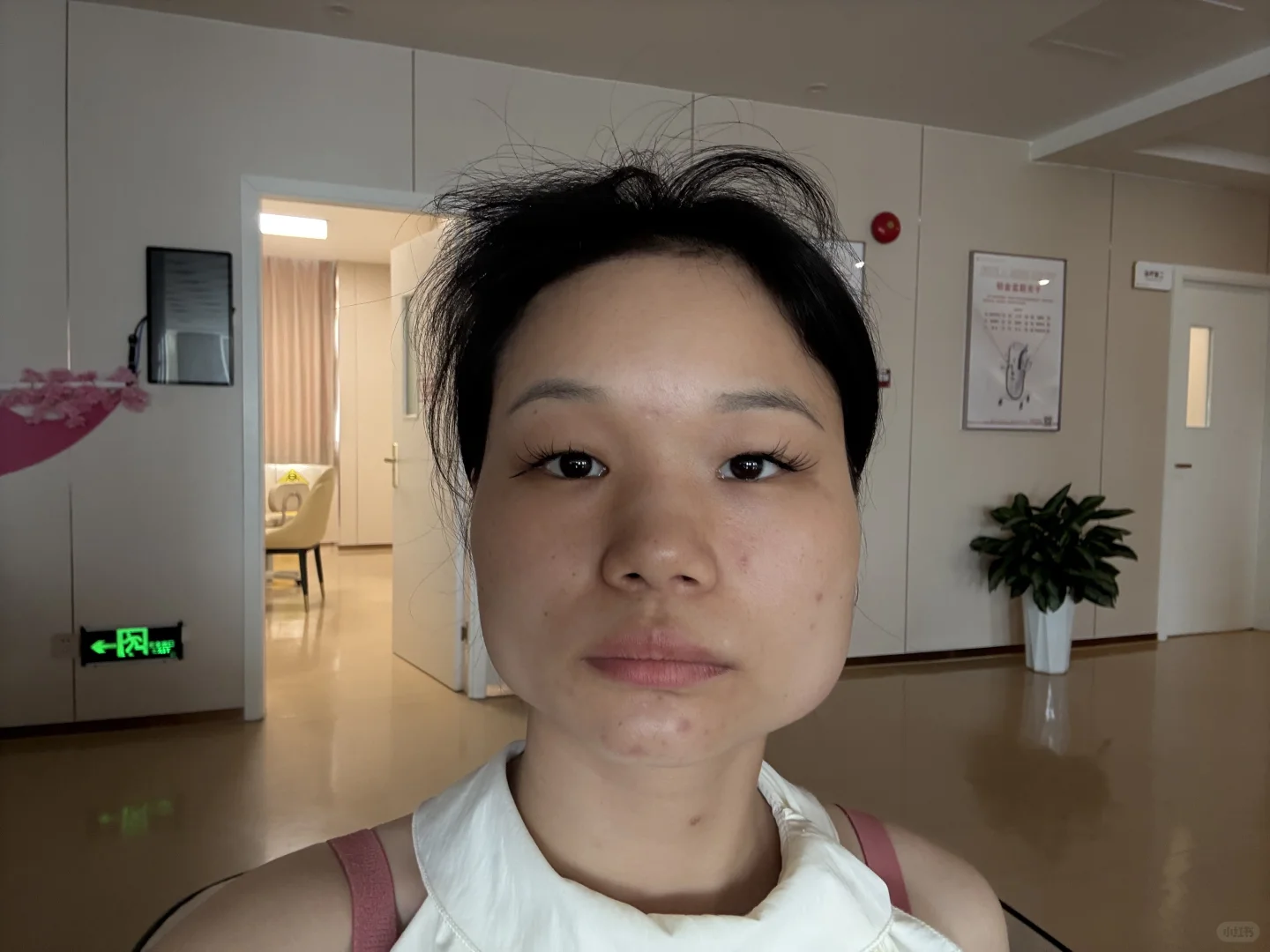 瘦脸 肉毒素